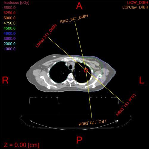 Medical x-ray showing bone with two linked black gaps.